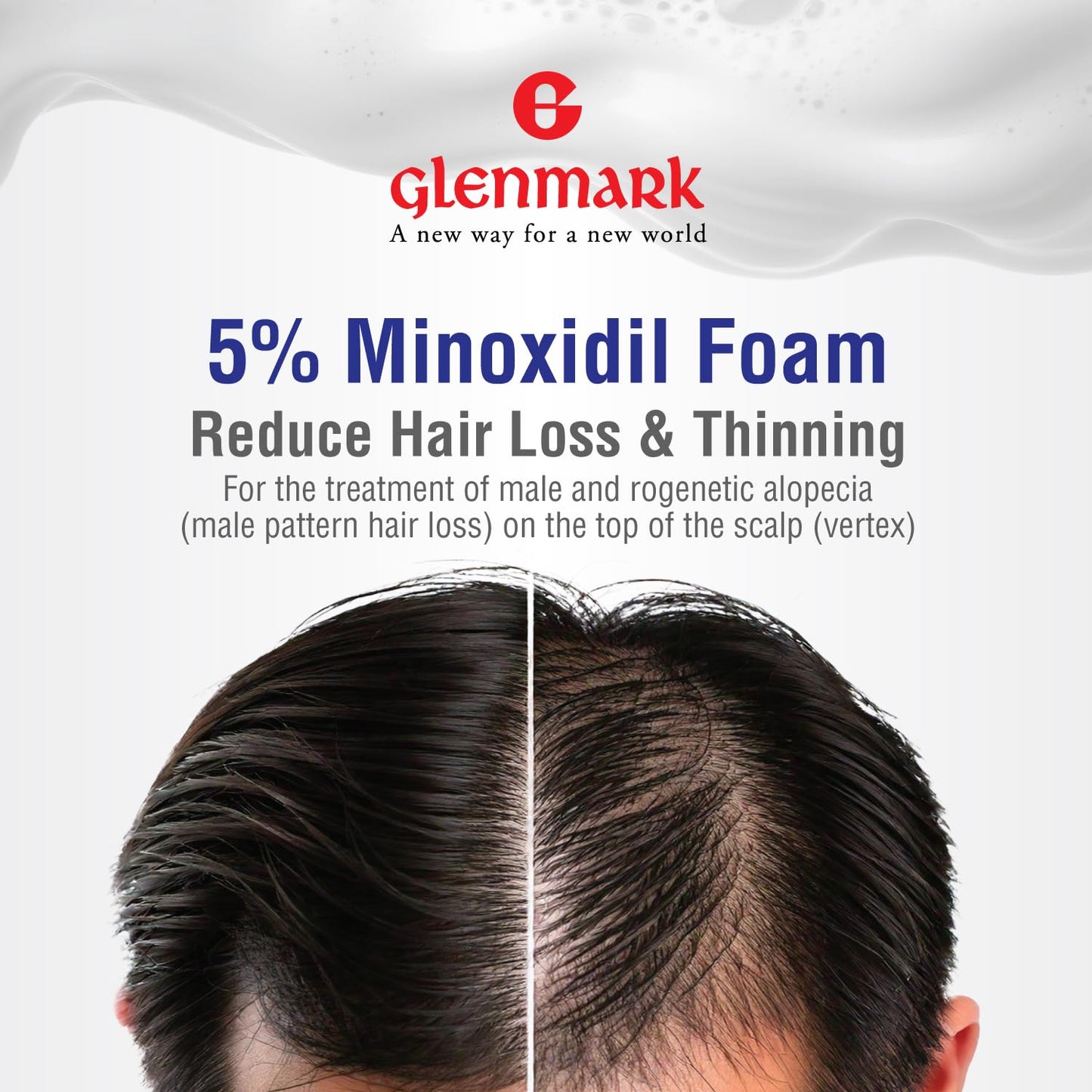 Glenmark | Minoxidil 5% Hair Regrowth Foam for Men, Aerosol Can, 1 Month Treatment (60 gr) โ Mess-Free, Fast-Drying Formula for Thinning Hair & Hair Loss โ Reactivates Follicles ๐ All In One Marketplace Canada