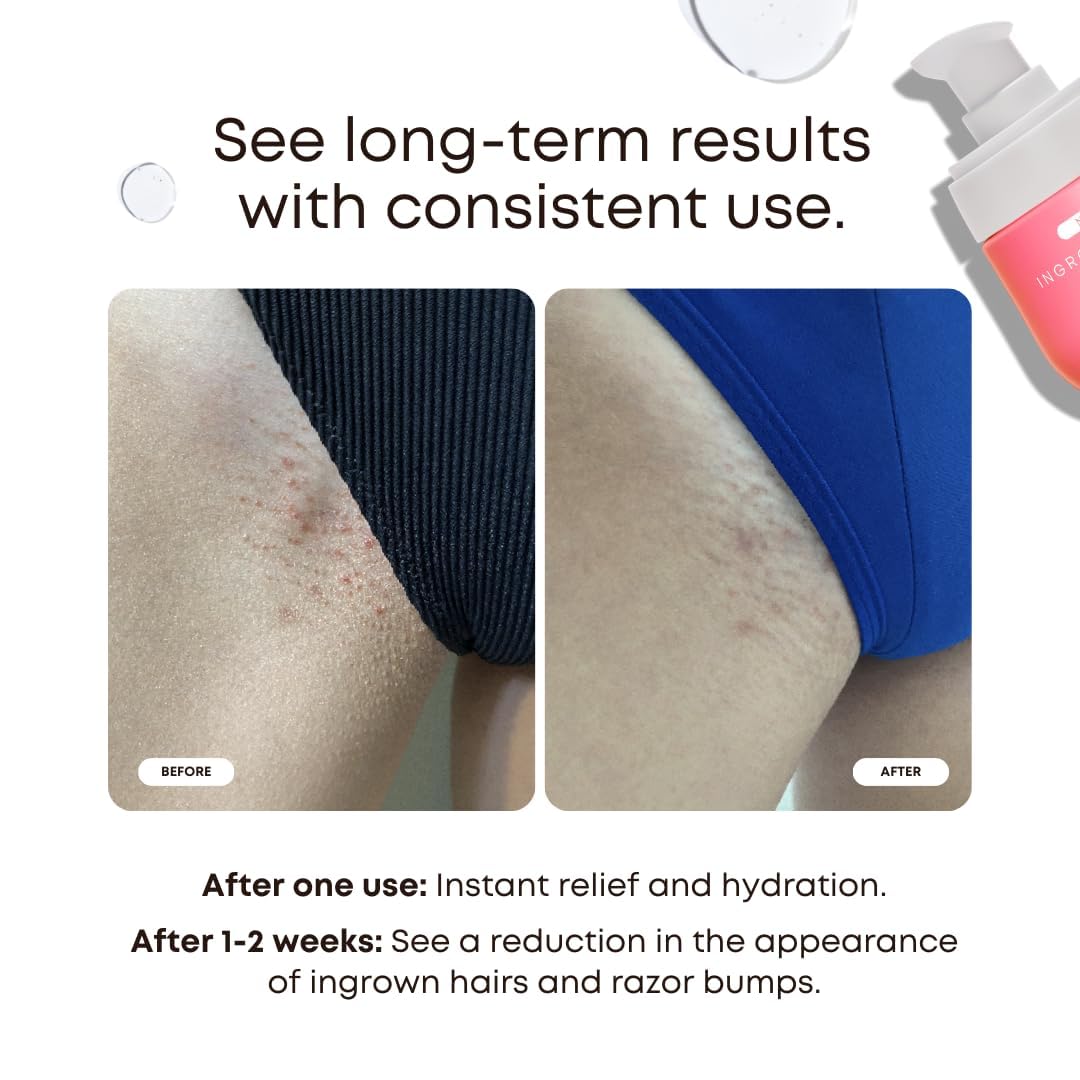 Bushbalm Ingrown Hair Oil - Targets Ingrown Hairs, Razor Bumps and Post Shave Irritation - Soothes and Hydrates Skin, 30 ml - Watermelon Sugar 🍁 All In One Marketplace Canada