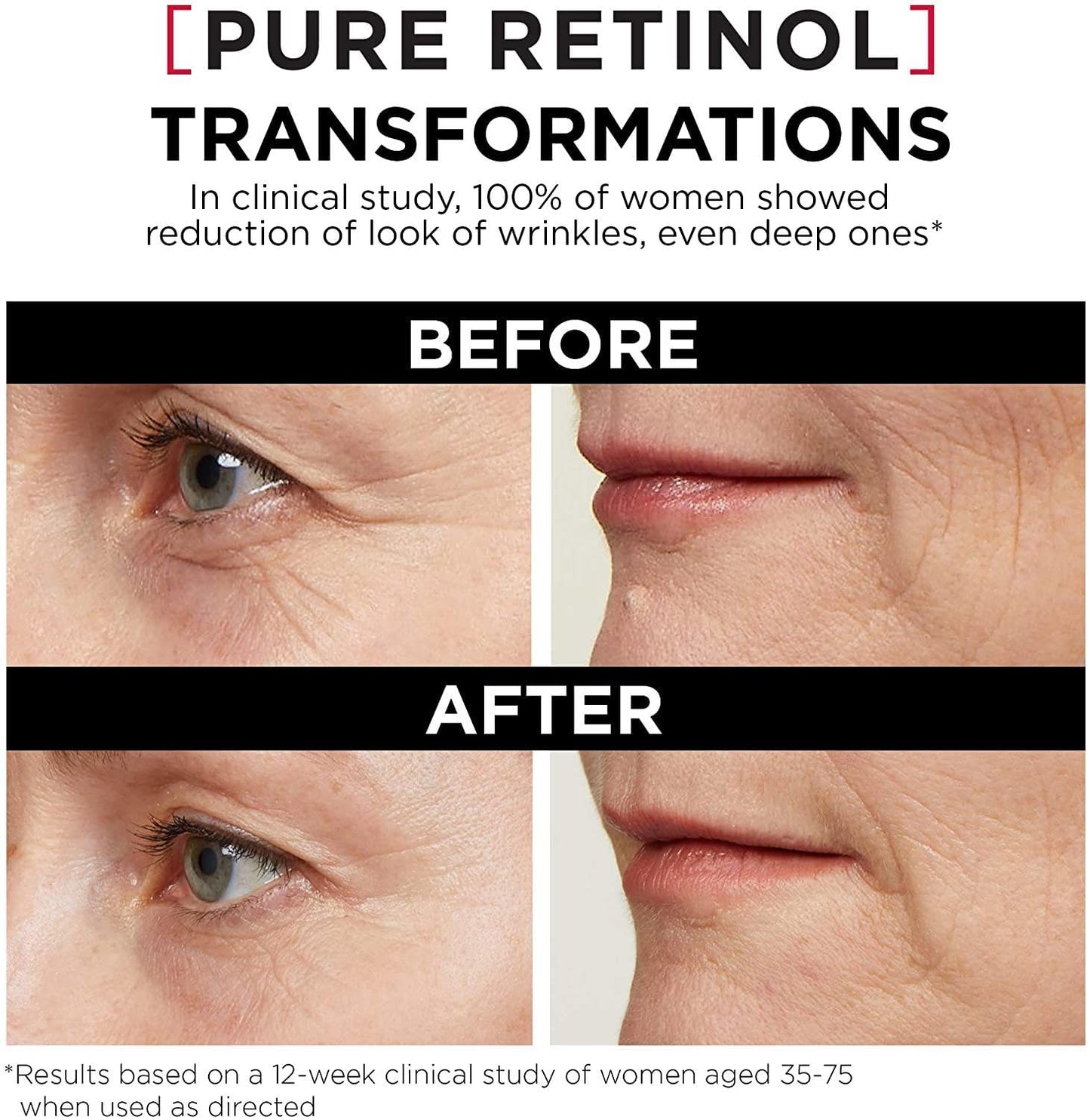 L'Oreal Paris 0.3% Pure Retinol Serum for Face, Night Serum Visibly Reduces the Look of Deep Wrinkles & Smoothes Texture, Revitalift Derm Intensives, 30ml 🍁 All In One Marketplace Canada
