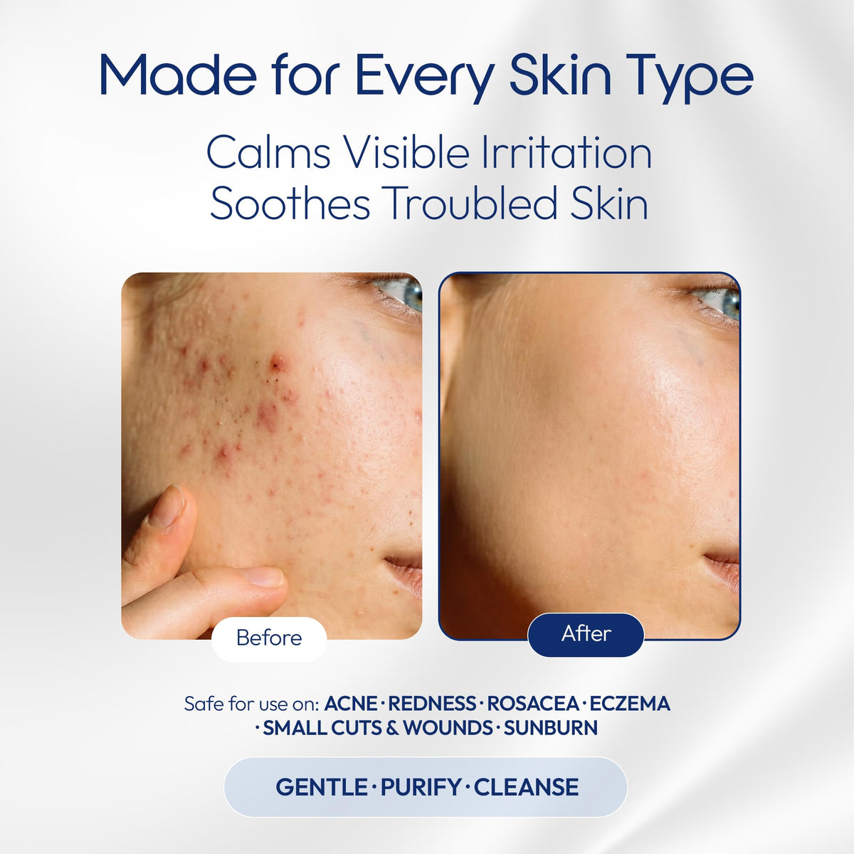 Hypochlorous Acid Spray – Acne Prone Skin – Dry Face – Eczema Prone Skin - Tattoo Aftercare – Piercing Aftercare – Saline Toner – Facial Cleanser – Eye Lash Cleanser - All Natural Face and Skin Spray – Safe for All Skin Types – Hypoallergenic – Cruelty Fr