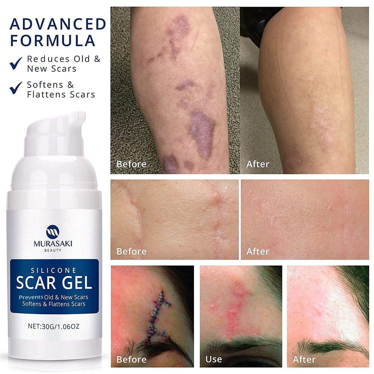 100% Silicone Scar Gel Scar Cream - Advanced Scar Gel for Old and New Scars 🍁 All In One Marketplace Canada
