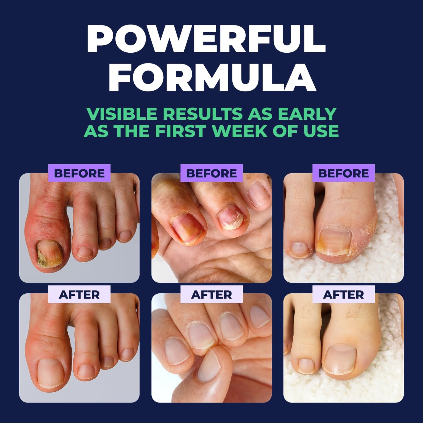 Orivelle Toenail Care Pen - Extra Strength Toe Nail Remedy - Professional Nail Solution for Fingernail with Tea Tree Oil (Pack of 4) 🍁 All In One Marketplace Canada