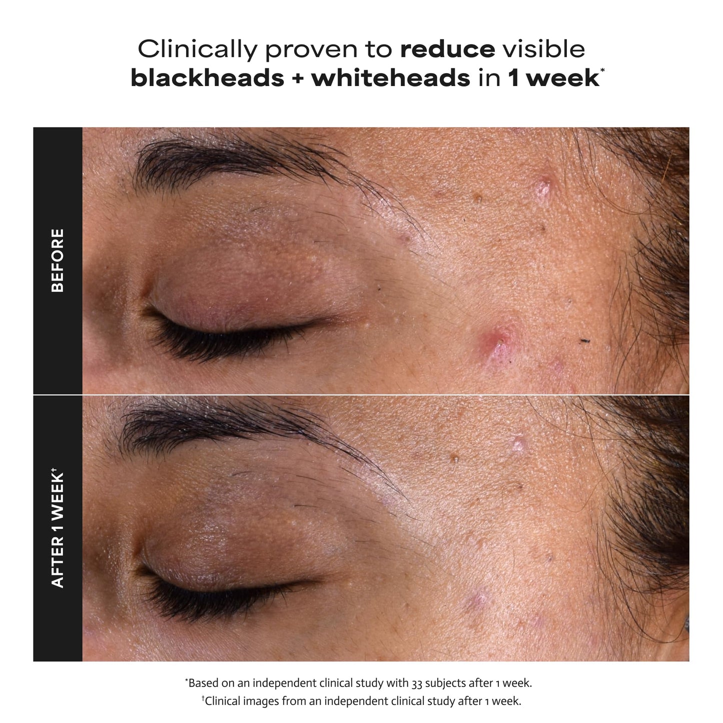 Paula's Choice SKIN PERFECTING 2% BHA Liquid Salicylic Acid Exfoliant, Daily Facial Exfoliator for Enlarged Pores, Wrinkles & Fine Lines, Fragrance-Free, Full Size - 118 ml 🍁 All In One Marketplace Canada