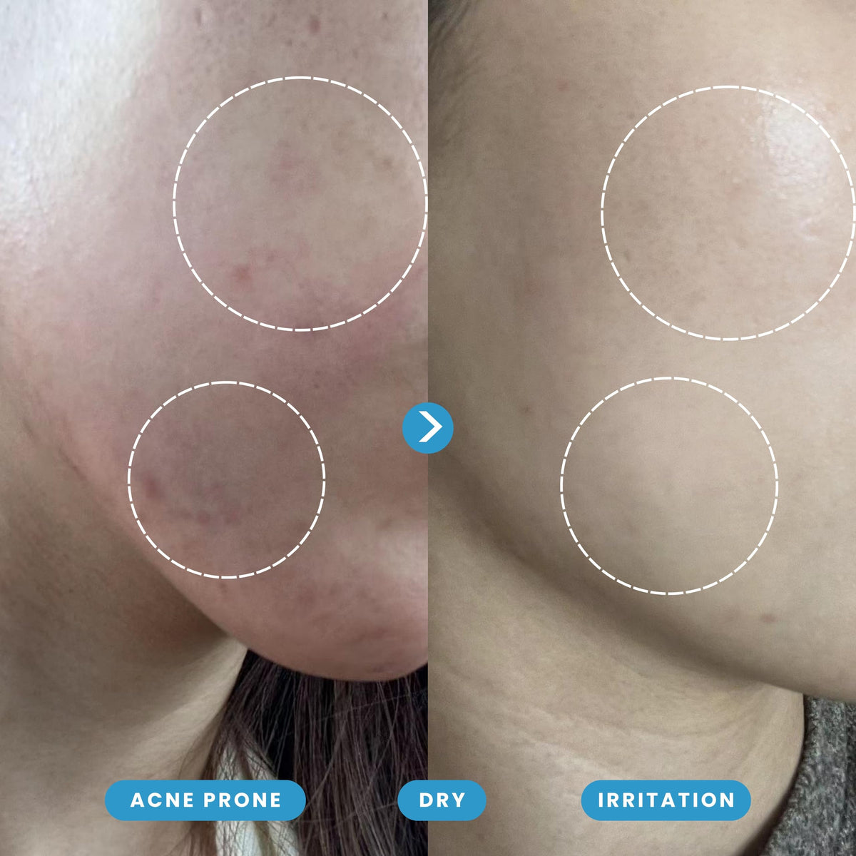 Hypochlorous Acid Spray – Dermatologist Tested HOCl Facial Cleanser for Sensitive, Acne-Prone & Irritated Skin – Soothes Redness, Eczema, Rashes & Itching – Skin Repair Spray, 200 mL - Honeydew Labs 🍁 All In One Marketplace Canada