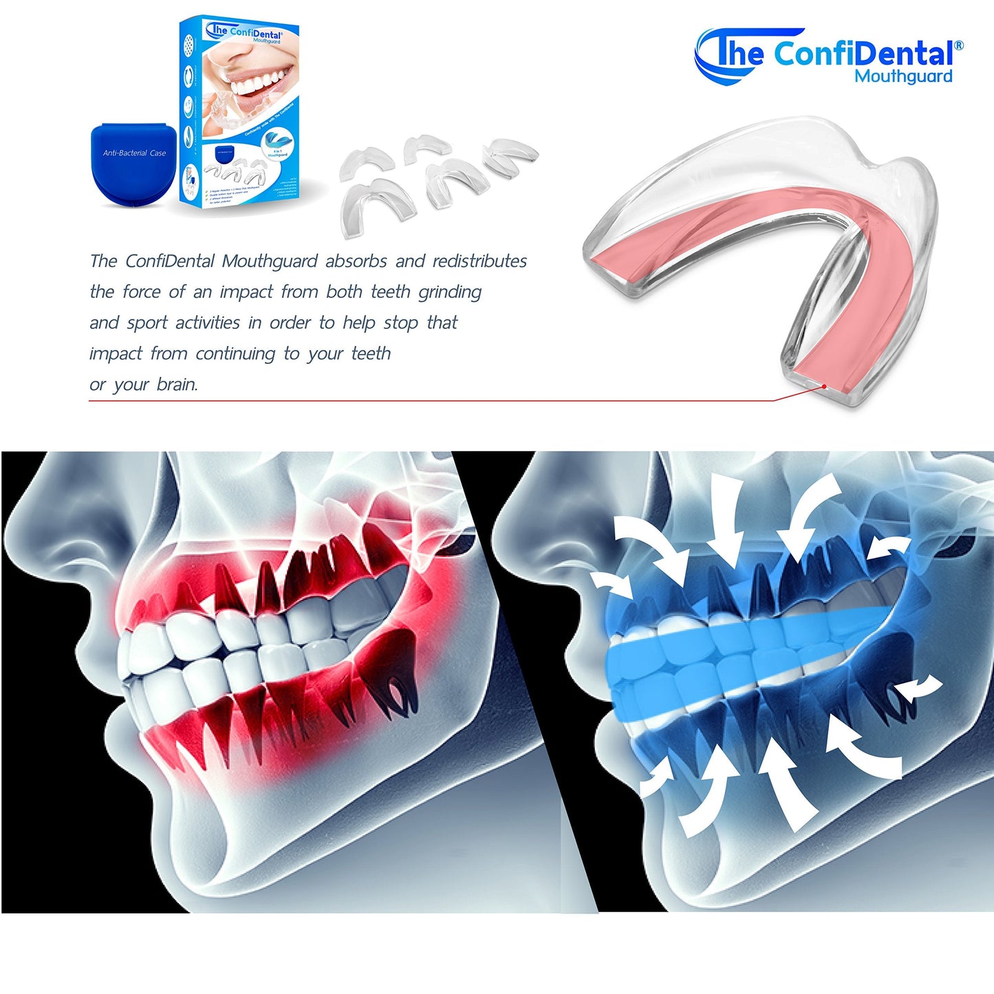 The ConfiDental - Moldable Mouth Guard for Teeth Grinding Clenching Bruxism Sport Athletic Whitening Tray Pack of 5 Including 3 Regular and 2 Heavy Duty Guard (3 (Ill) Regular 2 (ll) Heavy Duty) 🍁 All In One Marketplace Canada